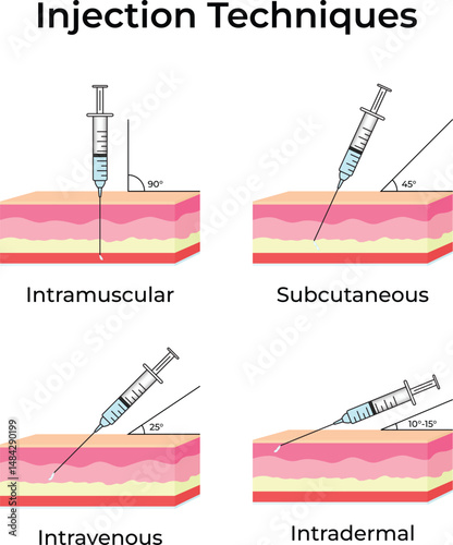 Different Injection Techniques Intramuscular Subcutaneous Intravenous and Intradermal