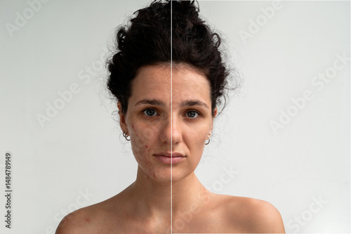 Valokuva A shot of the face and body of a young woman with skin problems - pimples, acne, enlarged pores