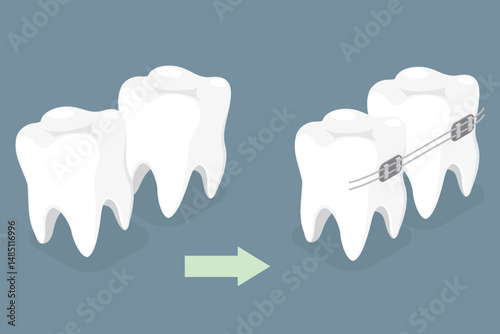 Dental stomatology braces on teeths. Orthodontic concept. Isometric vector illustration
