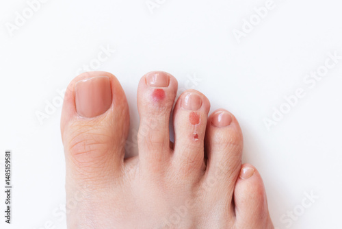 Woman suffering from calluses on her toes, formed after walking in uncomfortable shoes. View from above