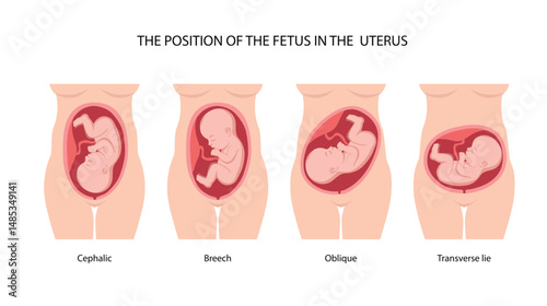 Different baby positions in the womb during pregnancy, Cephalic, Breech, transverse, Oblique lies. Colored medical poster, banner. Fetus, Unborn Baby