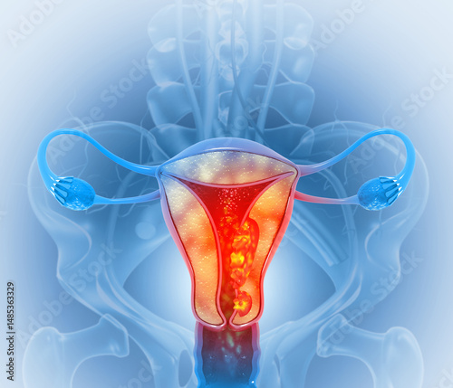 Uterus or uterine cancer. Medical concept as cancerous cells spreading in a female reproductive system. 3d illustration