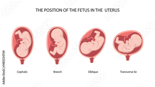 Different positions of the fetusin the uterus during pregnancy, Cephalic, Breech, transverse, Oblique lies. Colored medical poster, banner. Fetus, Unborn Baby