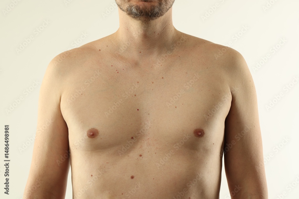 Fototapeta premium Man with moles on his skin against light background, closeup