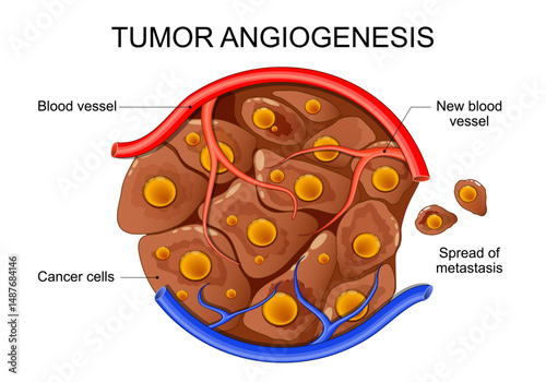 Tumor angiogenesis. Cancer cell development and metastasis