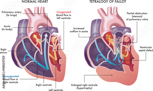 Illustration showing a normal heart and one with symptoms of Tetralogy of Fallot, a cardiovascular disease, with annotations.