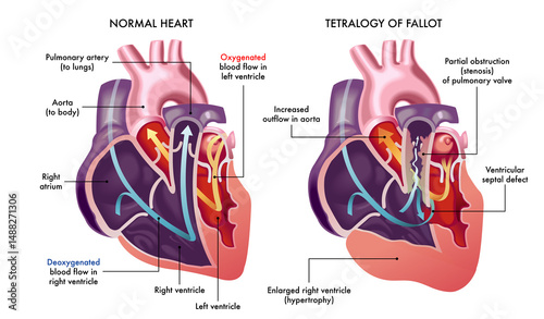 Illustration showing a normal heart and one with symptoms of Tetralogy of Fallot, a cardiovascular disease, with annotations.