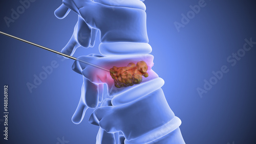 Vertebroplasty or Spinal Vertebrae Stabilization Using Bone Cement