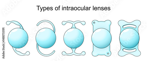 Types of intraocular lenses in Cataract surgery.