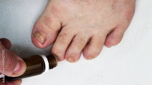 Treatment of foot fungus with drops.