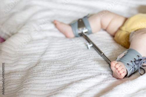 Infant's foot secured in a Wilensky splint, designed for treating hip dysplasia. The splint aids in optimal hip positioning, crucial for the child's development and mobility.