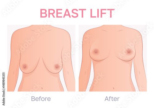Vector illustration showing comparison  between before and after breast lift plastic surgery. Two images showing the result of mastopexy. Breast ptosis treatment.