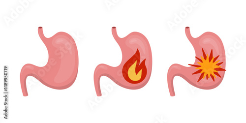 Stomach with heartburn and stomach ulcer on white background