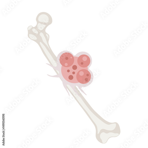 Bone cancer like osteosarcoma and adamantinoma affects bones; related tumors include Ewing sarcoma and chondrosarcoma.diagnosis aids treatment and improves outcomes