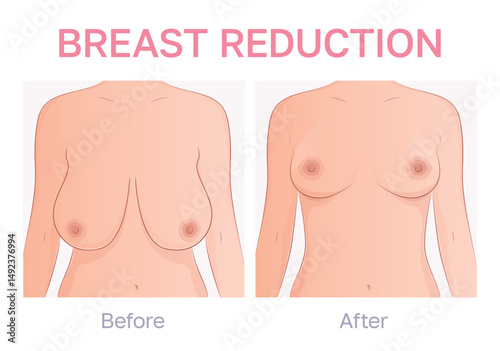 Vector illustration showing comparison  between before and after breast reduction mammaplasty. Breast ptosis treatment.