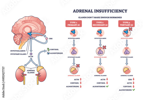 Adrenal insufficiency diagram shows hormone pathways, highlighting brain, adrenal glands, and hormone flow. Outline diagram