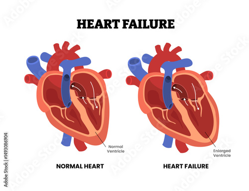 Heart failure, educational medical poster design healthcare scheme, internal organs, cardiovascular disease, heart complication. Labeled enlarged ventricle. Diastolic Dysfunction preserved ejection.