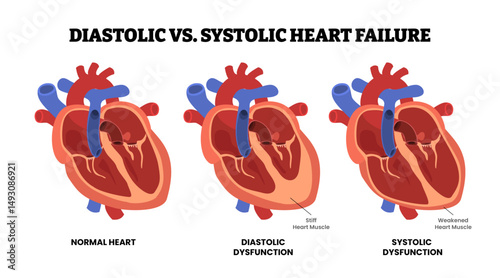 Diastolic VS Systolic Heart Failure, educational medical poster design healthcare scheme, internal organs, cardiovascular disease, heart complication. Labeled stiff and weakened heart muscle.