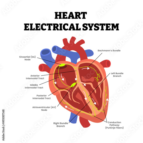 Heart Electrical System, educational medical poster design healthcare scheme, internal organs, cardiovascular disease, heart complication. Sinoatrial Node (SA), Atrioventricular Node (AV), internodal.