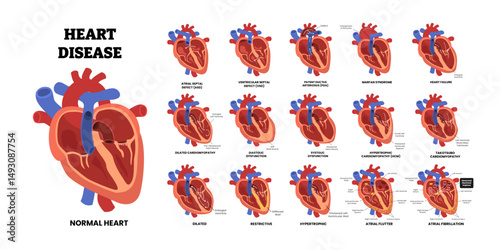 Heart Disease Set, educational medical poster design healthcare scheme, internal organs, labeled Atrial Fibrillation, Atrial Flutter, Atrial Septal Defect ASD, Diastolic Dysfunction Heart Failure.