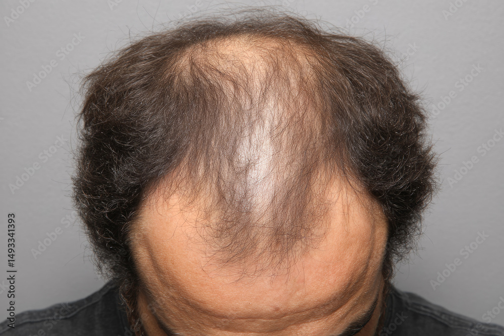 Man with thinning hair and bald spot top of his head is shown from above, highlighting hair loss. image captures texture and pattern of hair, emphasizing contrast between bald area and remaining Man with thinning hair and bald spot top of his head is shown from above, highlighting hair loss. image captures texture and pattern of hair, emphasizing contrast between bald area and remaining