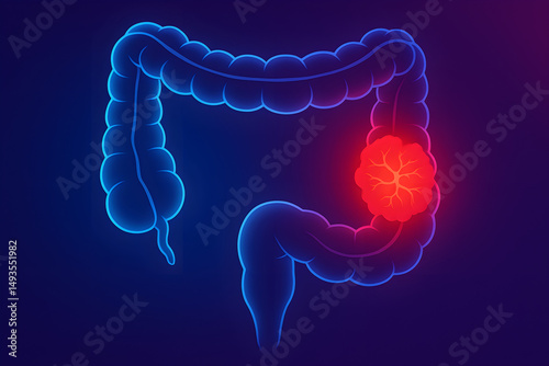 colorectal cancer, bowel cancer, colon cancer, rectal cancer, tumor, organ, body, human, doctor, hospital, gastroenterologist, proctologist photo