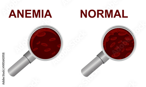 Normal and anemia icon. vector