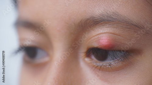 Young woman with eye infection, sty, hordeolum. Concept of health, disease and treatment