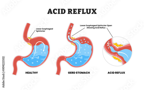 Acid reflux or GERD or Gastroesophageal reflux stomach disease, educational medical poster design healthcare scheme, human stomach internal organs. Labeled lower esophageal sphincter open.