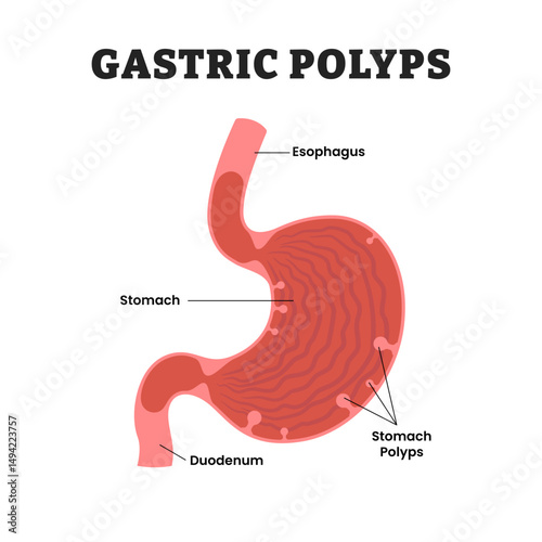 Gastric Polyps Stomach Disease or mesenchymal polyps, educational medical poster design healthcare scheme, human stomach internal organs. Labeled esophagus, duodenum, abnormal growth.