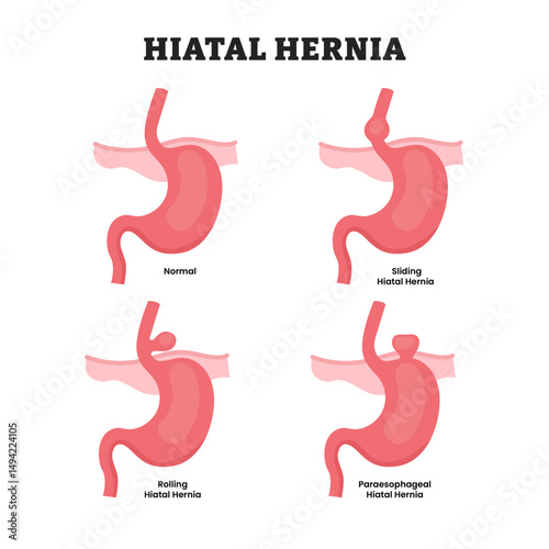 Different types of hiatal hernia stomach disease, educational medical poster design healthcare scheme, human stomach internal organs. Labeled sliding, rolling, paraesophageal. Diaphragm opening.