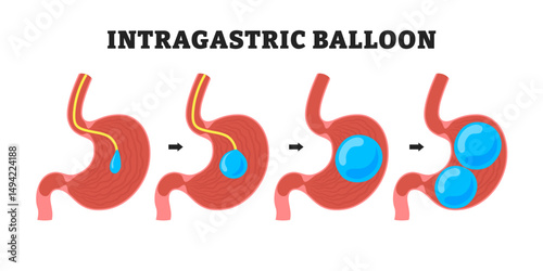 Intragastric Balloon for weight loss procedure, educational medical poster design healthcare scheme, human stomach internal organs. Labeled dual and single gastric balloon. Inflatable medical device.