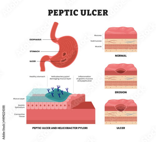 Peptic Ulcer, educational medical poster design healthcare scheme, human stomach internal organs. Labeled mucosa, submucosa, normal, erosion, ulcer skin layers. Helicobacter Pylori Bacteria.