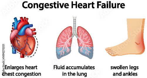 Congestive Heart Failure Medical Illustration