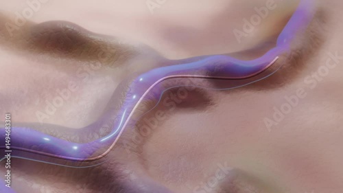 Endovenosus Thermal Ablation