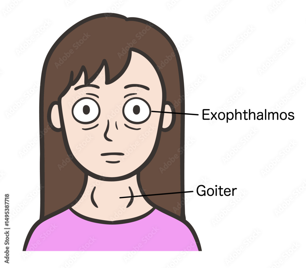 バセドウ病の症状が出ている女性の顔