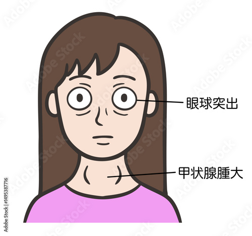 バセドウ病の症状が出ている女性の顔