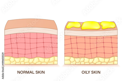 Structure of oily skin. Comparison of normal and oily skin. Facial skin problems. Vector for advertising about beauty and medical treatment.