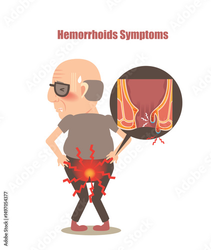 Hemorrhoids Symptoms