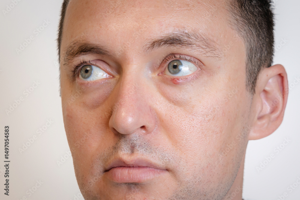 Obraz premium Man's eyes with pus redness like chalazion caused by blocked sebaceous glad on lower eyelid. Hordeolum. Viral infection