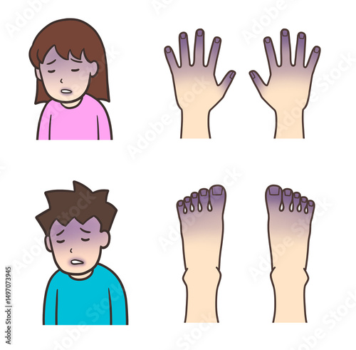 チアノーゼの視覚的兆候、手足と唇の紫色の変色