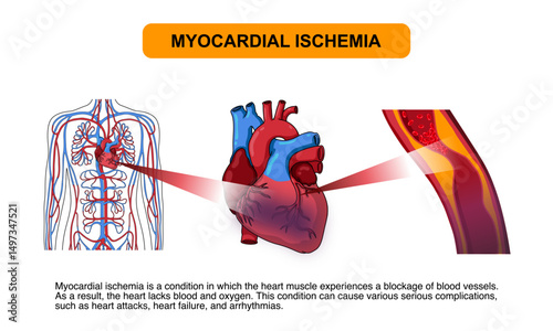 myocardial ischemia, cardiac ischemia, cholesterol in human blood vessels. Fat, plaque and calcium, in arteries, veins. Vascular blockage, embolism. Illustration Poster for medical, clinic or science 