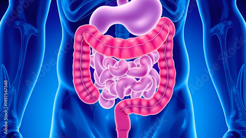 Baby diarrhea disorder intestinal disease of Hirschsprung's nerves inflammation blocked swollen belly tummy ache sepsis Down keyhole peritonitis incontinence large intestine photo