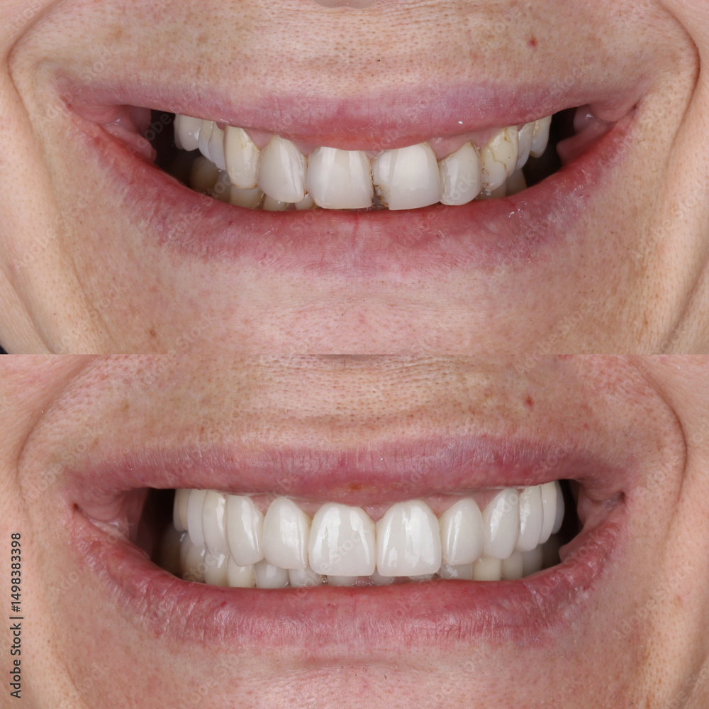 Fototapeta premium Smile design treatment with cosmetic dentistry. Laminate veneers and zirconia porcelain for a new smile through dental design. Dental before after and smile makeover.