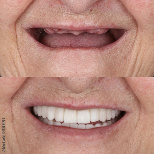 Full-arch denture prosthesis with dental implants placed in the jawbone. Full arch implant treatment with porcelain prosthesis. Dental before after and smile makeover.

