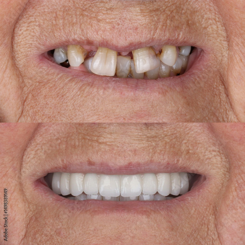 Full-arch denture prosthesis with dental implants placed in the jawbone. Full arch implant treatment with porcelain prosthesis. Dental before after and smile makeover.

