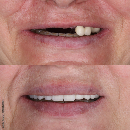 Quadro em tela Treatment of front incisors with dental implants through oral surgery
