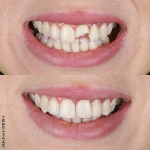 Treatment of deformed and discolored teeth with composite filling in dental care. Filling treatment for decayed teeth. Dental before after and smile makeover.

 photo