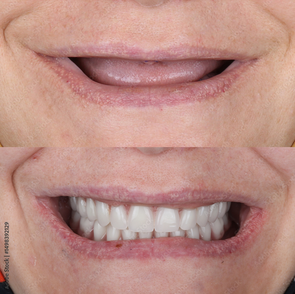 Obraz premium Full-arch denture prosthesis with dental implants placed in the jawbone. Full arch implant treatment with porcelain prosthesis. Dental before after and smile makeover.