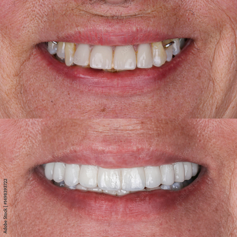 Fototapeta premium Full-arch denture prosthesis with dental implants placed in the jawbone. Full arch implant treatment with porcelain prosthesis. Dental before after and smile makeover.